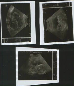 ultrasound20weeks.jpg
